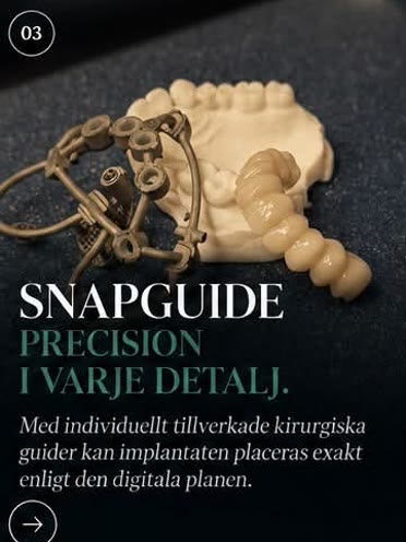 Steg 3: SnapGuide, precision i varje detalj. Individuellt tillverkade kirurgiska guider placerar implantaten exakt enligt den digitala planen.